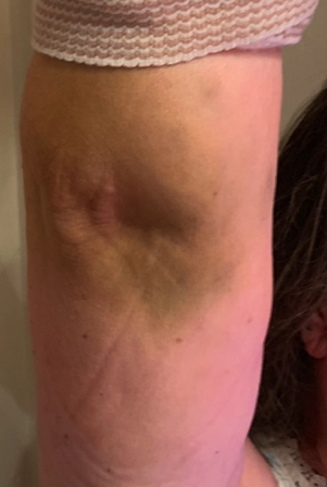 Dec 16 - Two weeks after my tumble I finally get a look at why my elbow has been so sore - quite the bruise! Dec 16 - Two weeks after my tumble I finally get a look at why my elbow has been so sore - quite the bruise!